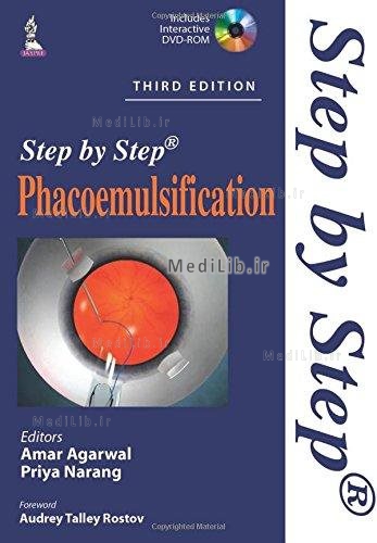 Step by Step Phacoemulsification