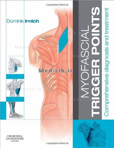 Myofascial Trigger Points