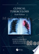 Clinical Tuberculosis