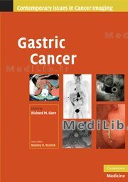 Gastric Cancer
