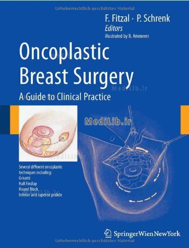 Oncoplastic Breast Surgery